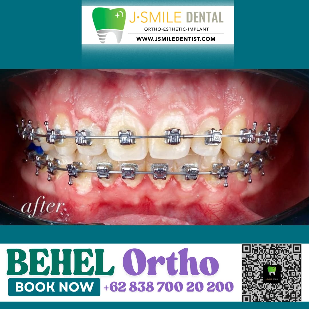 Hasil gigi rapi setelah perawatan behel ortodonti di J•SMILE Dental