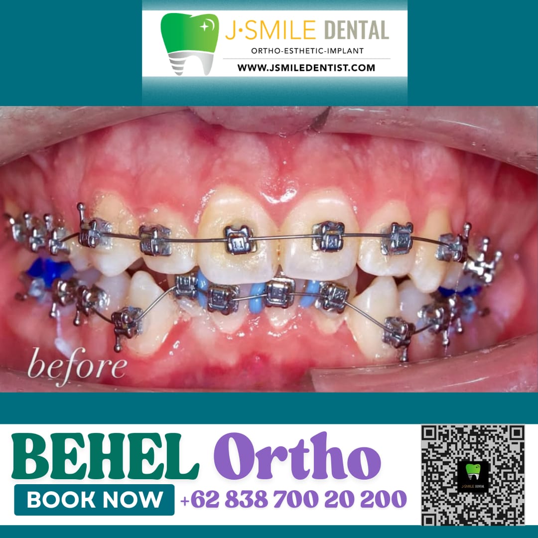 Kondisi gigi tidak rapi sebelum pemasangan behel ortodonti di J•SMILE Dental