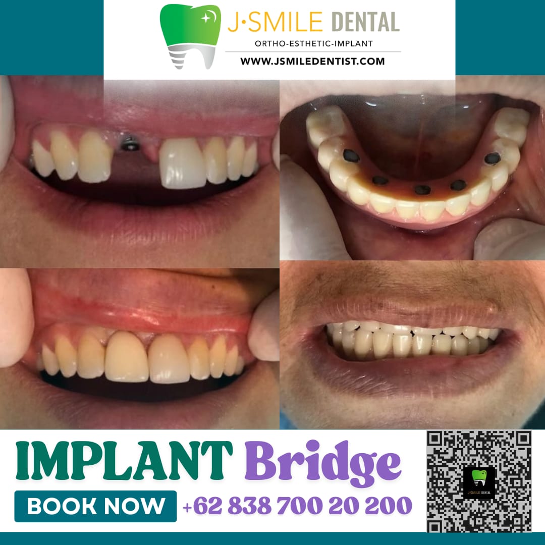 Hasil pemasangan implant bridge pada pasien J•SMILE Dental