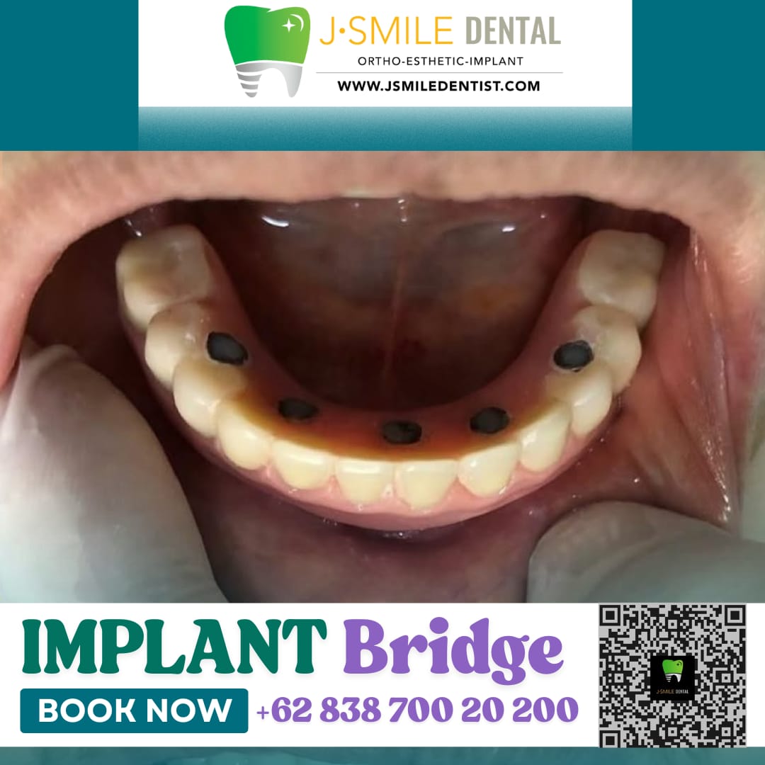 Hasil pemasangan implant bridge pada pasien J•SMILE Dental