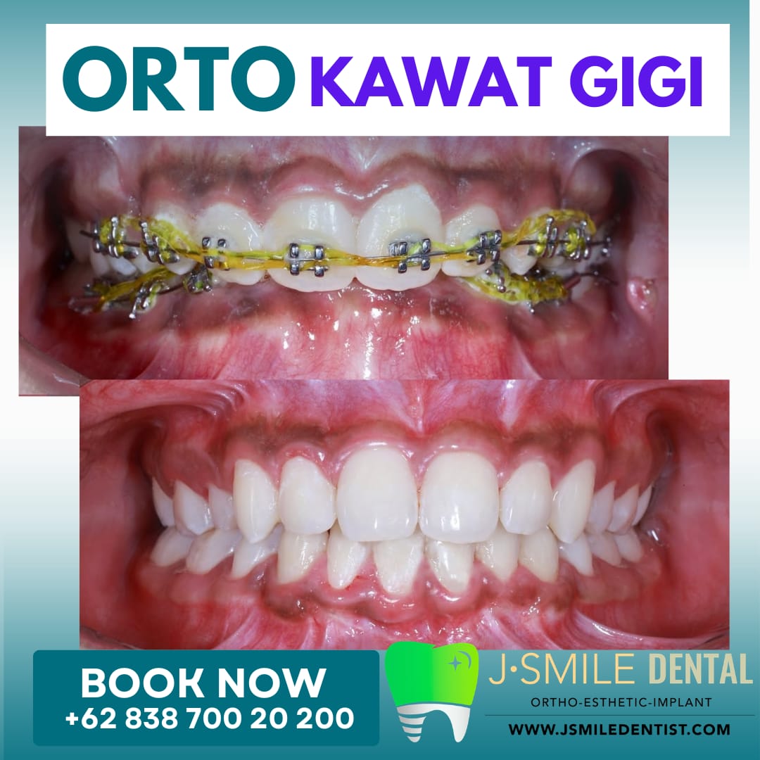 Perbandingan sebelum dan sesudah perawatan kawat gigi (behel) — kasus 2